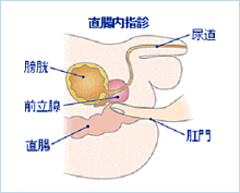 前立腺肥大症4