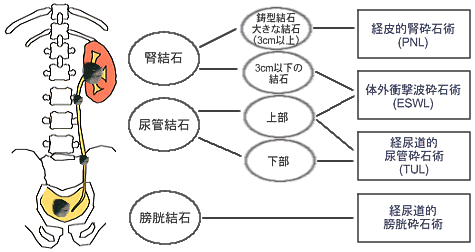 尿路結石症3