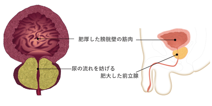 ウロリフト