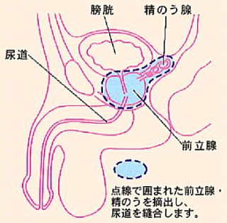 前立腺がん16