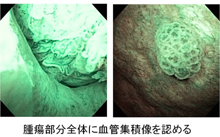 腫瘍部分全体に血管集積像を認める